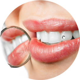 Ninth Incompatible Of storm Bijuteriile dentare - Best Dental