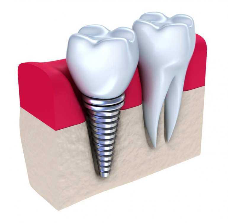 implant dentar